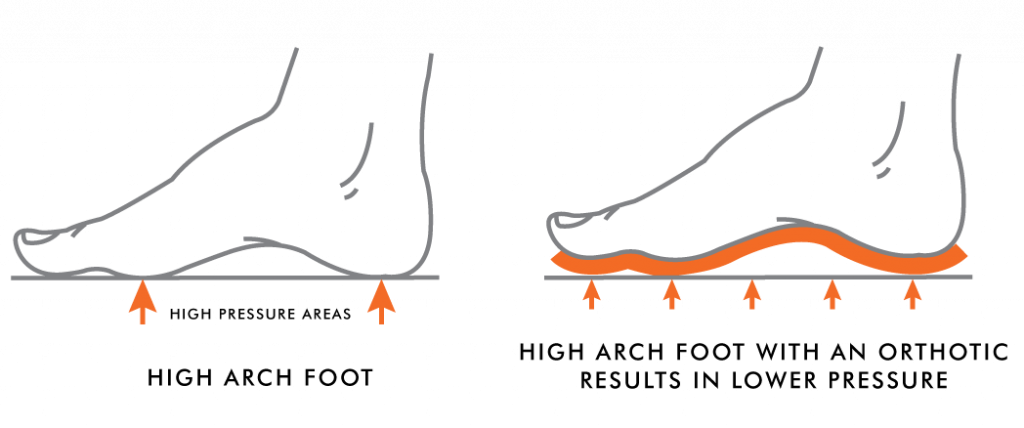 High Arches vs. Low Arches | Kintec: Footwear + Orthotics