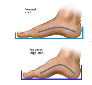 Flat Foot Vs High Arches