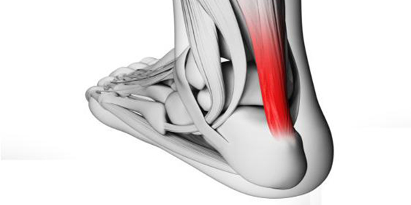 achilles tendonitis