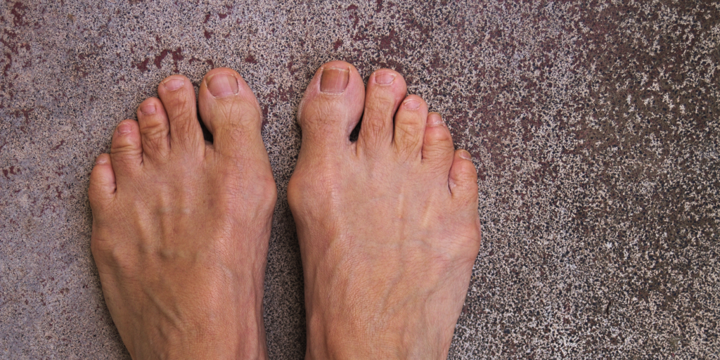 Here are the common causes of Bunions.