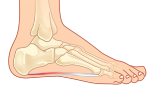 Plantar Fasciitis myths