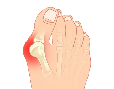 What Causes Bunions What You Can Do About Them Kintec