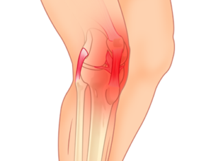 Knee Osteoarthritis (OA)