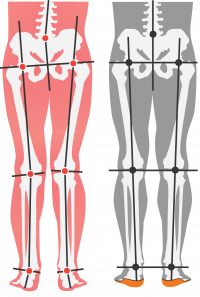 misaligned-vs-alignedwithorthotics