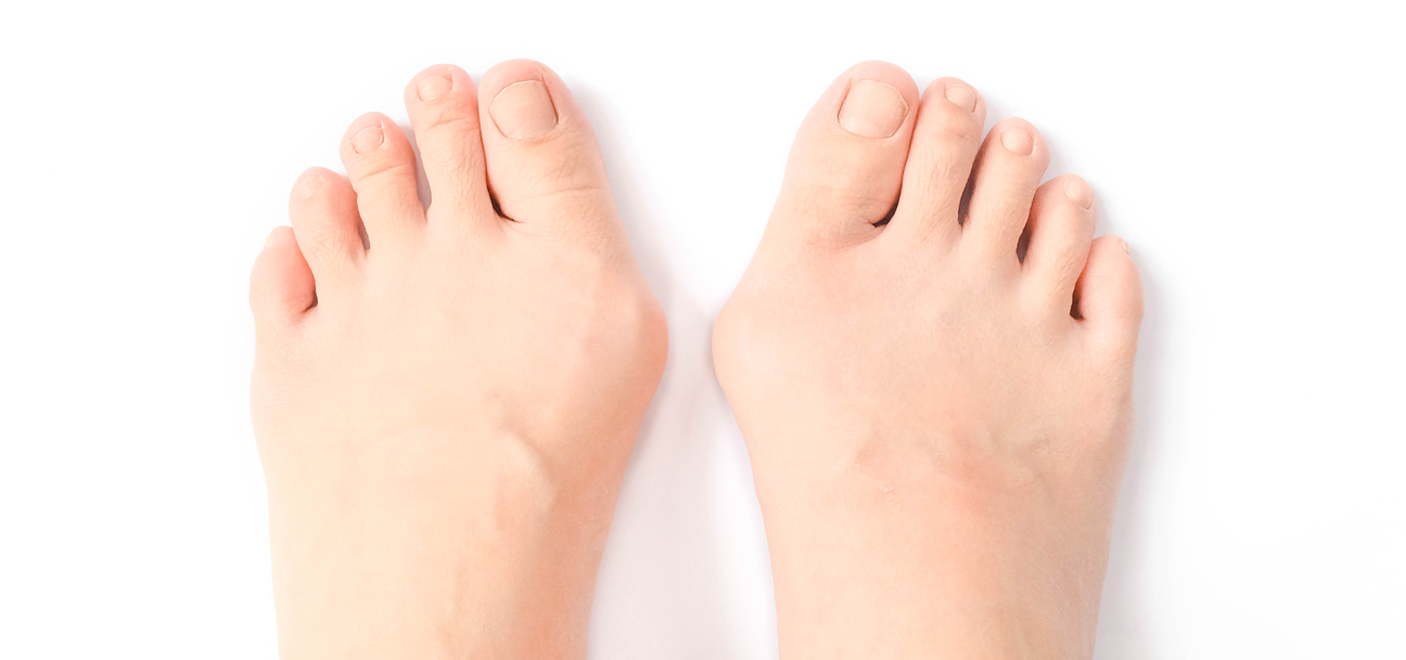 What causes bunions?