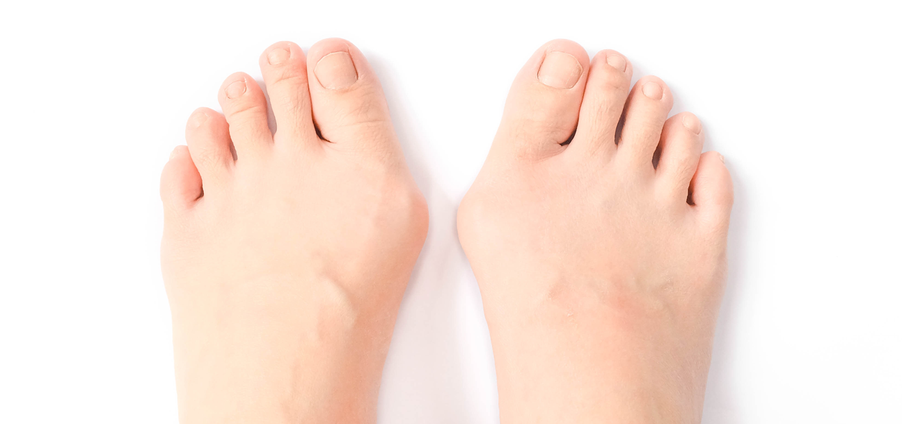 Do shoes deals cause bunions