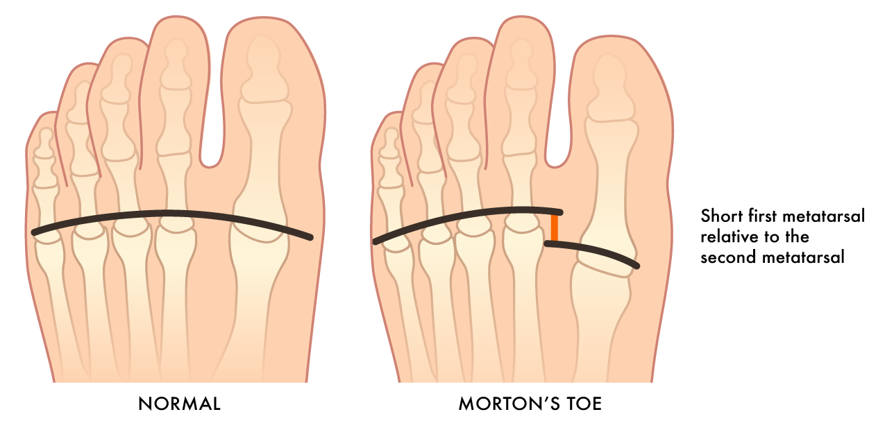What Causes Forefoot Pain? | Kintec