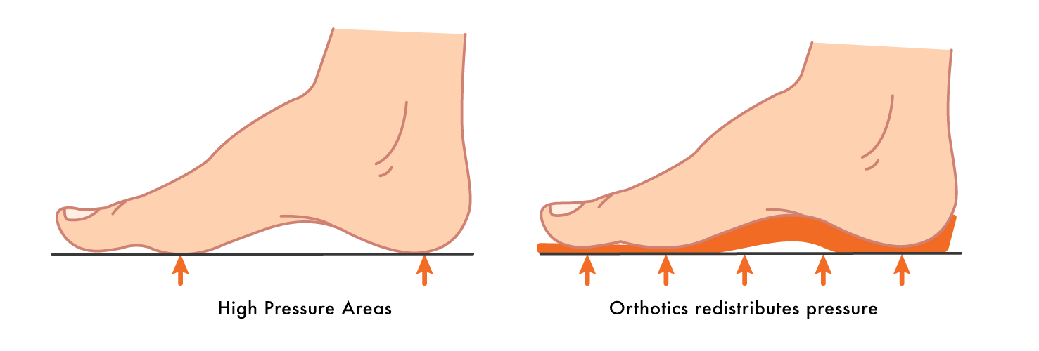 What Causes Forefoot Pain? Kintec